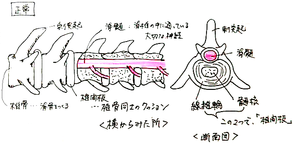 椎間板ヘルニア：正常