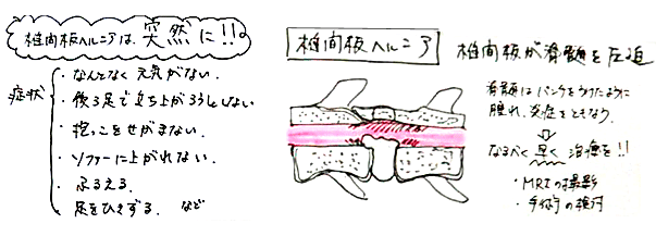 椎間板ヘルニアになってしまった状態